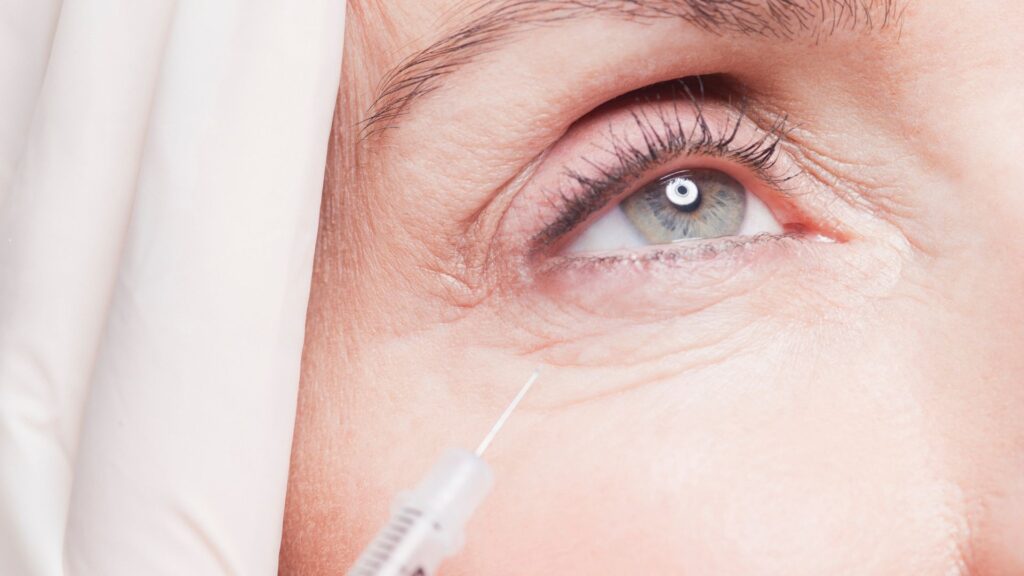 A closeup of woman's eyes - Tear Trough Filler