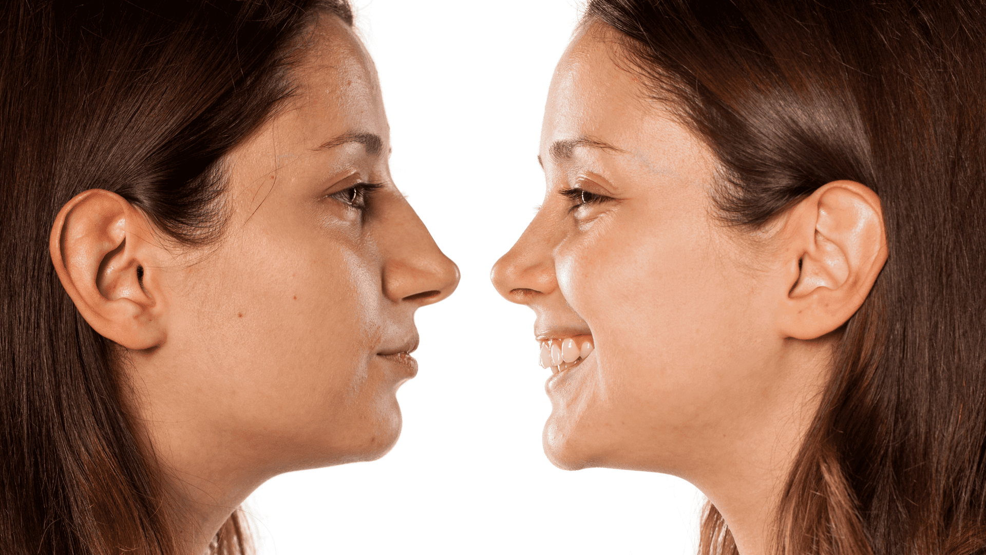 rhinoplasty-before-and-after