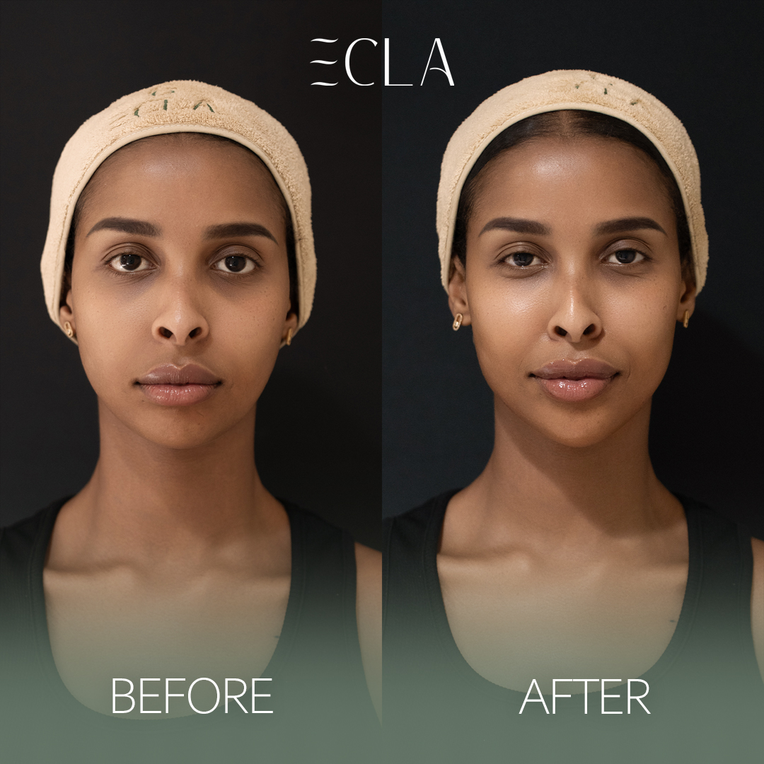 before and after eecla 11 ''