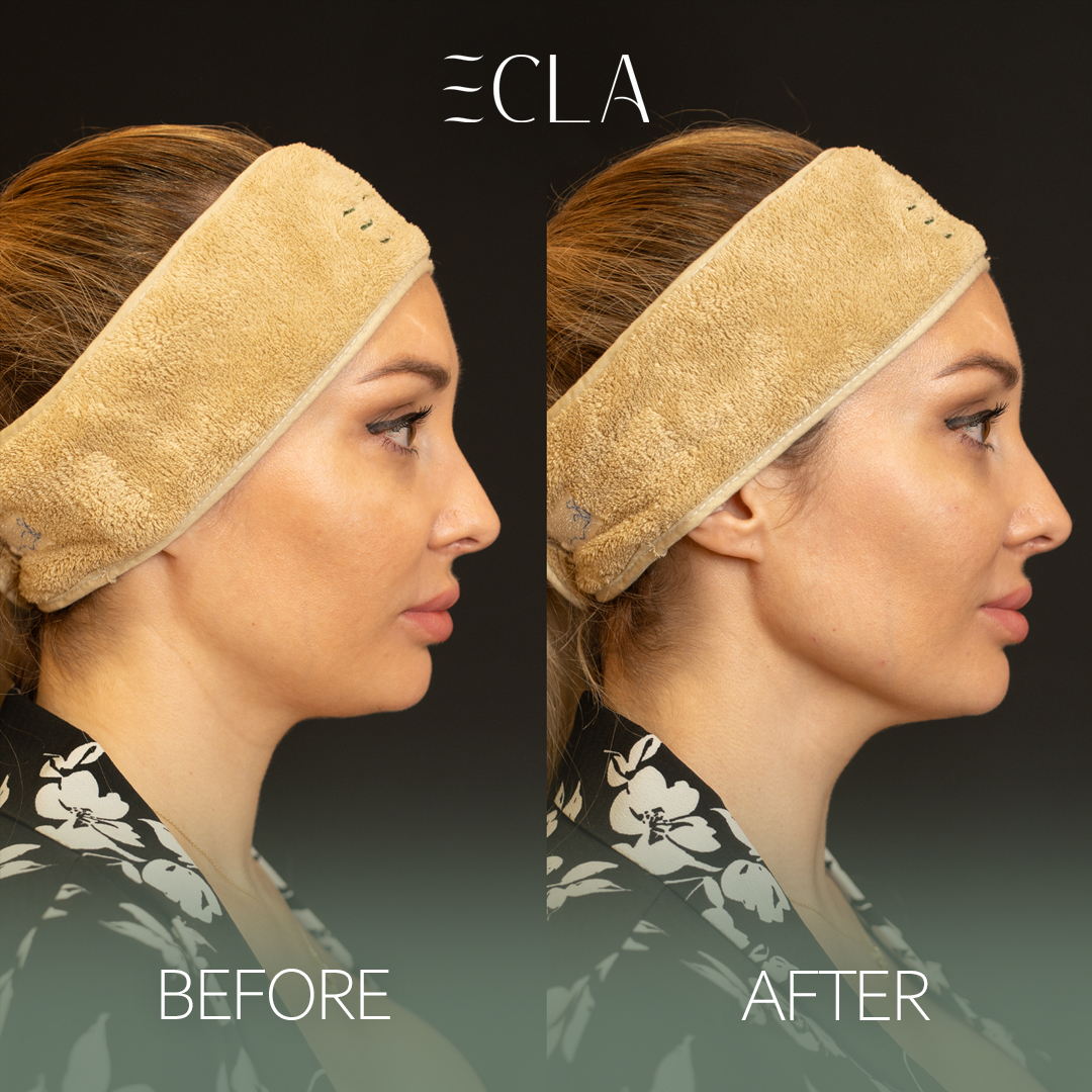 before and after eecla 11 77