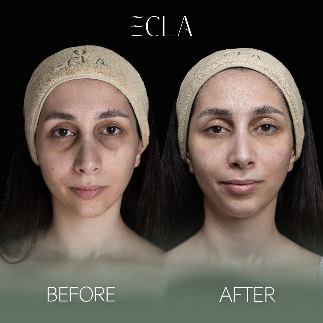 before and after eecla 11 copy layla