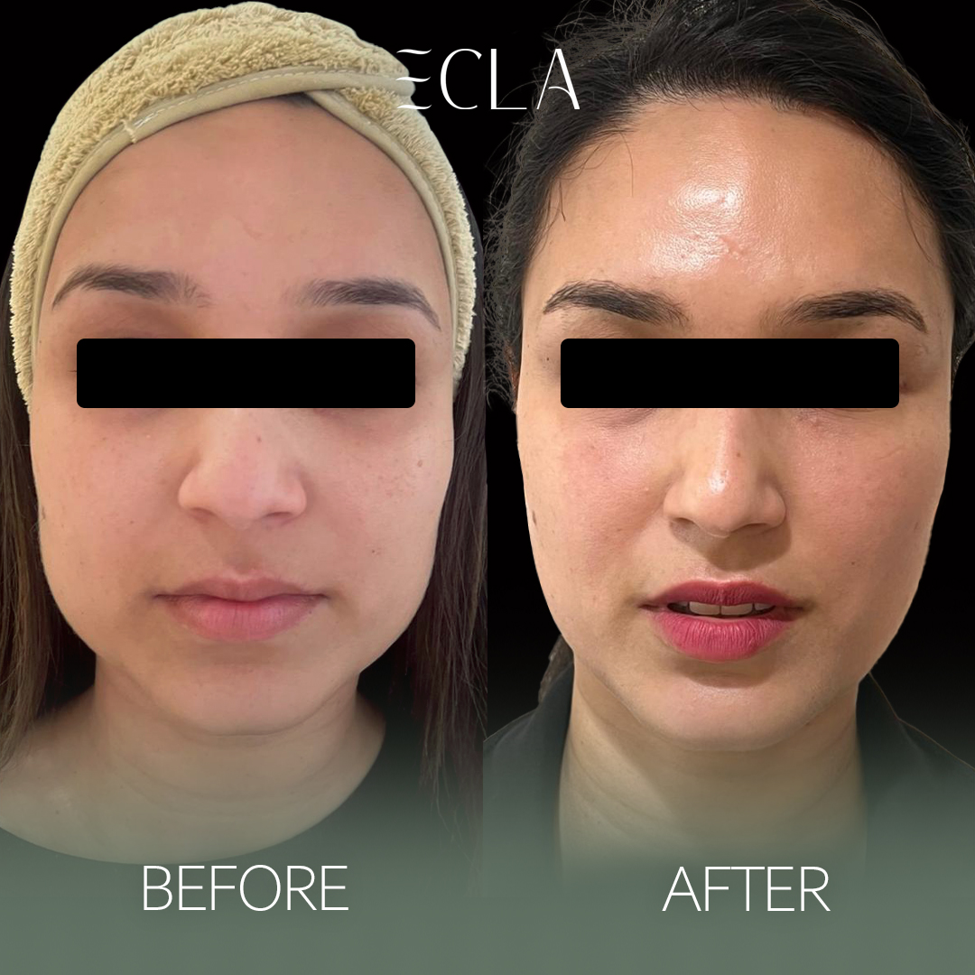 before and after eecla 11 copy2