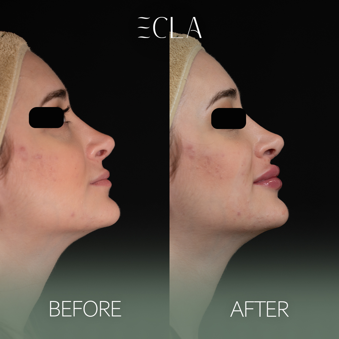 before and after eecla 1lips 1