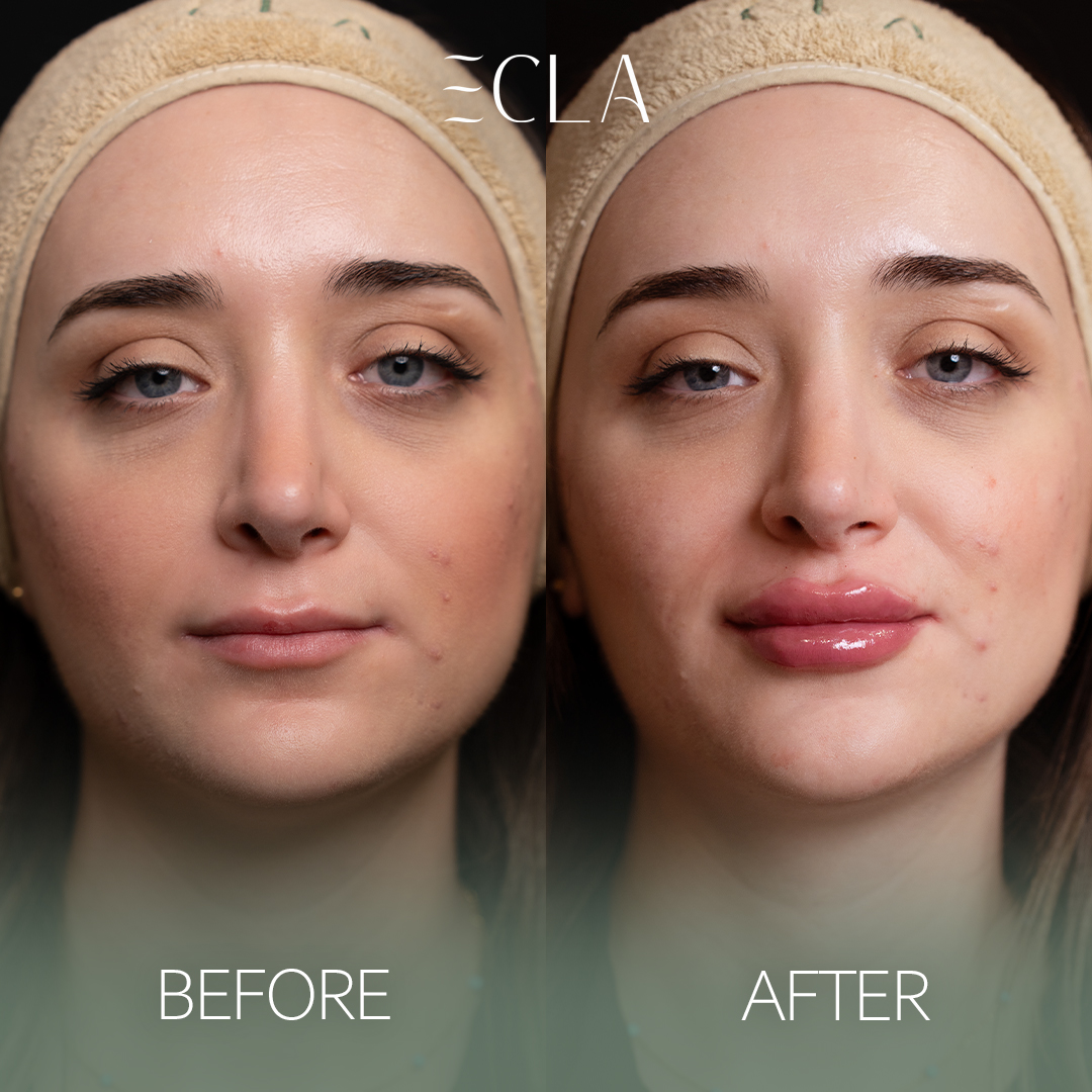 before and after eecla 1lips 2
