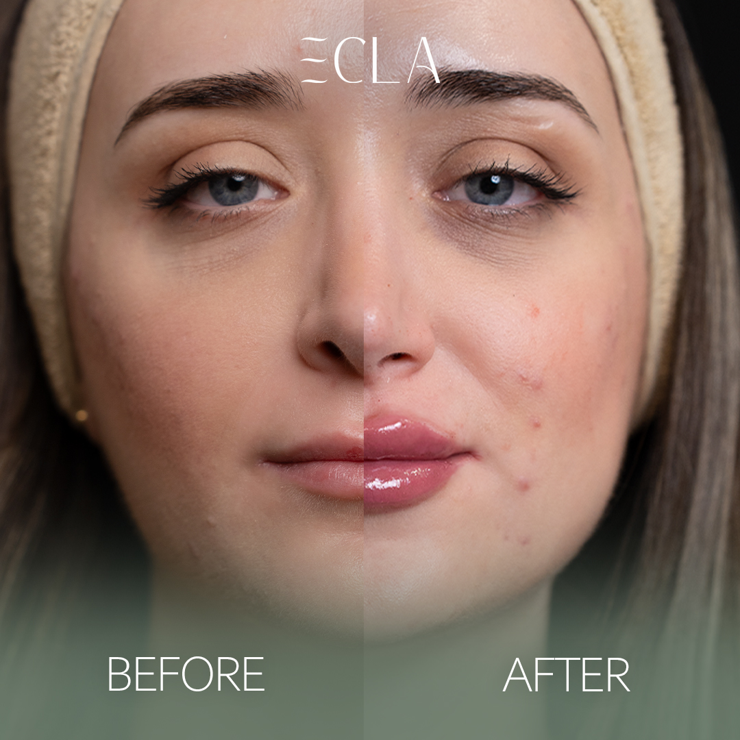 before and after eecla 1lips 3