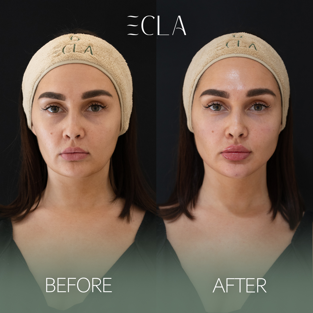 before and after eecla i