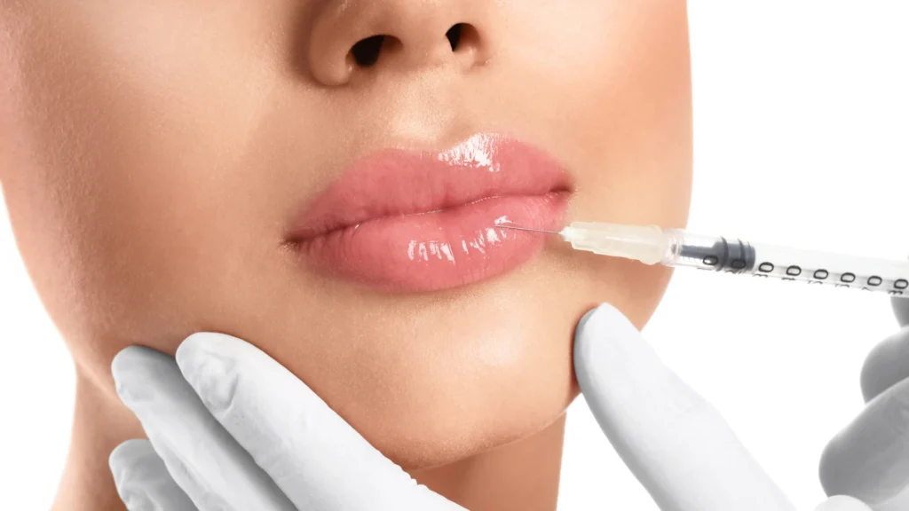 lip filler