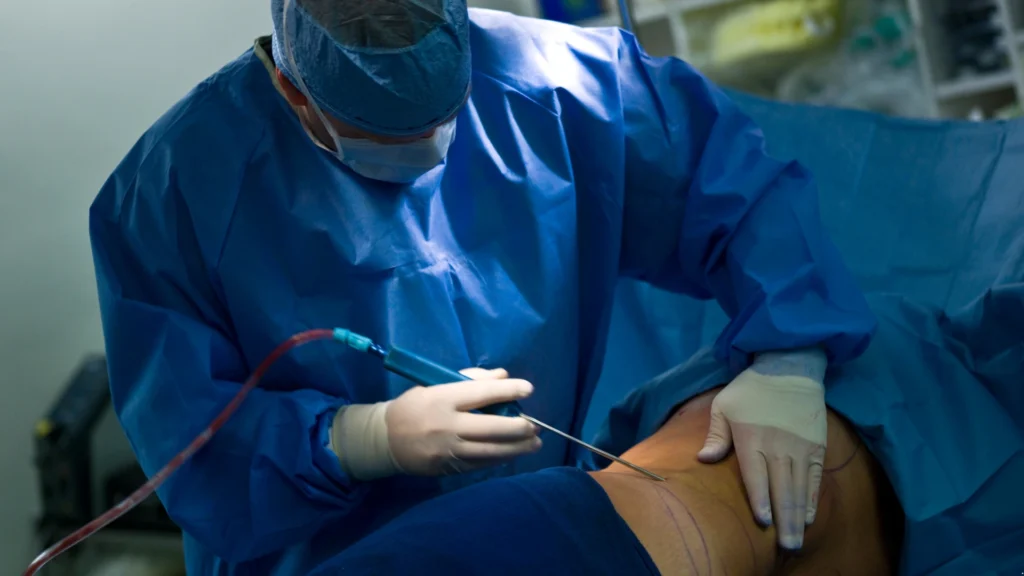 liposuction