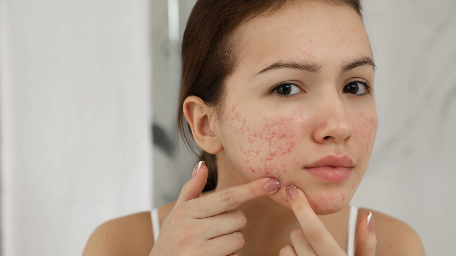 acne scars