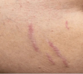 Stretch marks